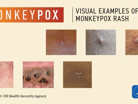 Local health experts explain Monkeypox